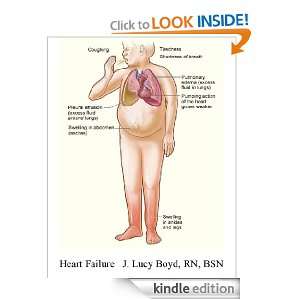  Patients Guide to Heart Failure Complex Issues Explained Simply J 
