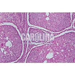 Human Carcinoma of Esophagus, sec. 7 um, H&E  Industrial 